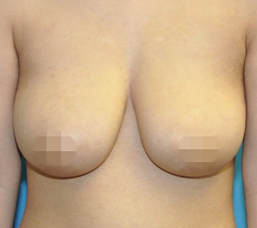 breast_lift_before