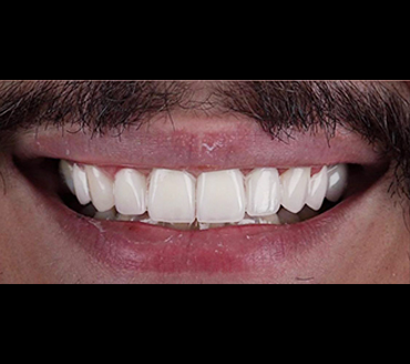 zirconium_after